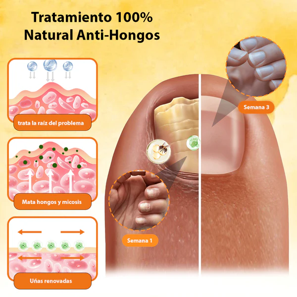 ¡Elimina la micosis de uñas en tiempo récord con HongoFree